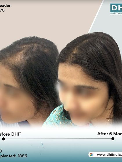 Another side-profile view of the same client's 6-month progress. The restored hairline and increased thickness are clearly visible, showcasing a natural and beautiful result.