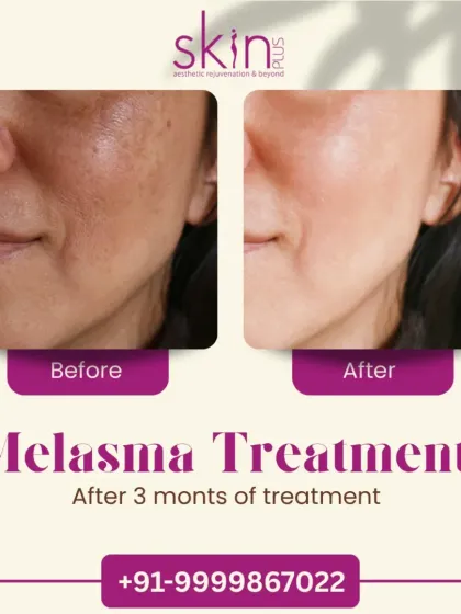 This before-and-after image displays the significant improvement in melasma after just three months of my customized treatment plan. It shows my capability in managing complex pigmentation issues and achieving a more even and radiant skin tone.