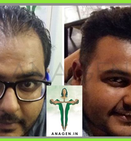 Another successful hair transplant using our advanced Instant BioFUE technique, resulting in a full and natural looking head of hair.