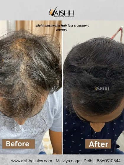 This patient's hair loss was treated non-surgically. This before-and-after shows a remarkable improvement in density and coverage in just two months.