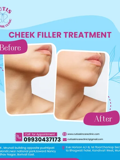 A before-and-after view of our Cheek Filler treatment. This demonstrates how we restore volume and create a subtle lift to the mid-face, enhancing the natural contours for a more defined and youthful profile.