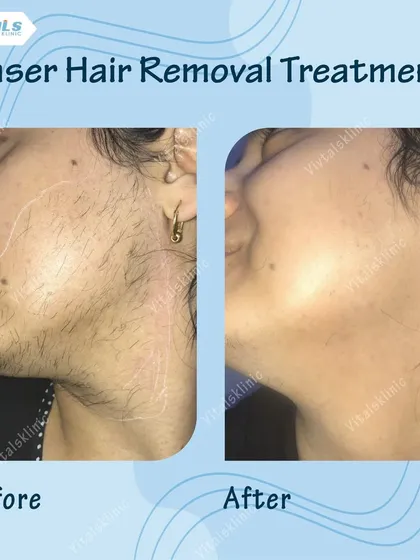 This before-and-after showcases the effectiveness of our USFDA-approved laser for facial hair removal. The treatment is precise and safe for Indian skin, providing a long-term solution to unwanted hair without irritation.
