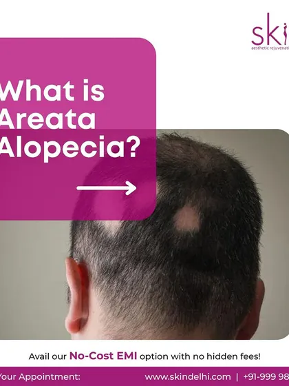 This image shows an example of Areata Alopecia, which is characterized by patchy hair loss. I provide targeted treatments to address this autoimmune condition and encourage hair regrowth in the affected areas.