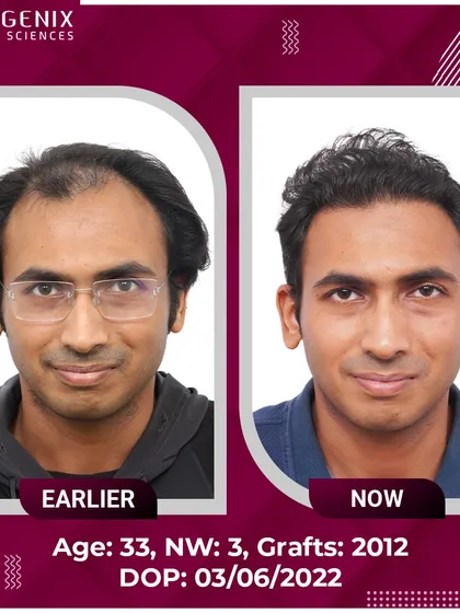 A 33-year-old's successful restoration from Grade 3 baldness with 2012 grafts.