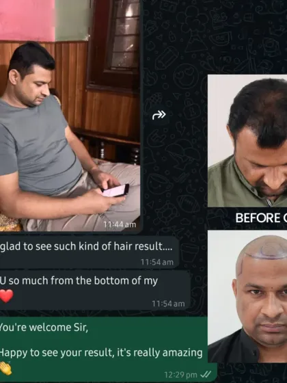 An unbelievable 5-month progress for our Delhi patient. His hairline is already visible, and confidence is restored, with full results still to come.