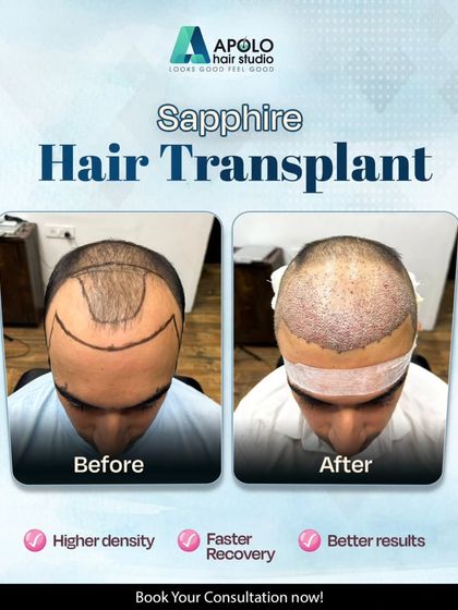This before and after image demonstrates the power of the Sapphire FUE technique. The 'after' shot, taken right after the procedure, shows the high density of implanted follicles, which leads to better results and faster recovery.