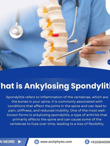 This graphic explains Ankylosing Spondylitis, a type of arthritis that affects the spine. Our physical therapy programs focus on improving flexibility and posture to manage symptoms and maintain mobility.