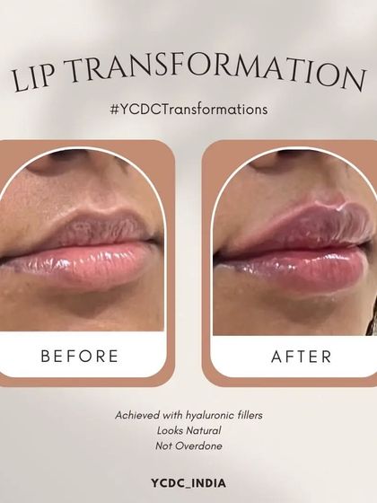 A subtle yet impactful lip enhancement using hyaluronic fillers. The goal was to define the lip border and add slight volume for a natural-looking pout, not an overdone appearance.