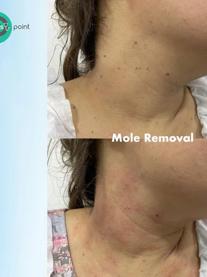 A clear demonstration of the effectiveness of our mole removal treatment. This before-and-after shot shows a significant reduction in moles on the neck, resulting in clearer, smoother skin.
