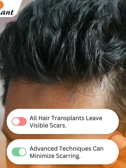 Myth: All hair transplants leave visible scars. Fact: Advanced techniques like FUE are virtually scarless. For FUT, I use a special trichophytic closure that minimizes scarring, making it nearly invisible.