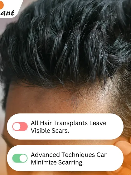 Myth: All hair transplants leave visible scars. Truth: Advanced techniques are designed to minimize scarring. With FUE, there are tiny, dot-like scars that are virtually invisible. With FUT, I use a special trichophytic closure so hair can grow through the fine linear scar, concealing it effectively.