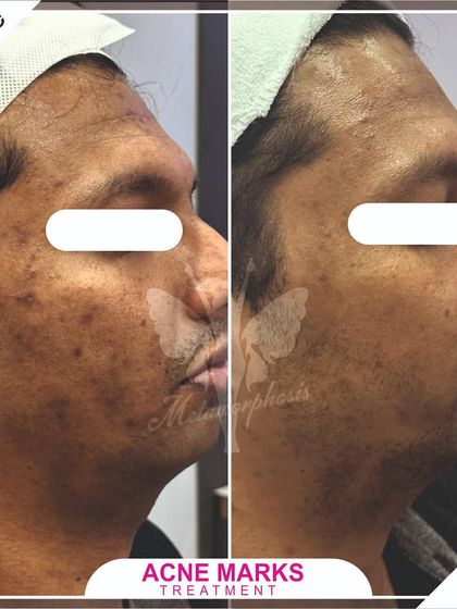This before-and-after for a male client demonstrates that acne marks can be effectively treated, resulting in smoother, clearer skin.