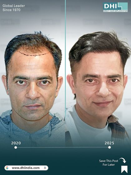 A frontal before and after comparison over 5 years. The client's restored hairline and confident smile in 2025 demonstrate the lasting, life-changing impact of a DHI hair transplant.