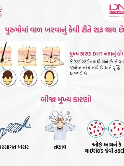 How does hair loss start in men? This graphic explains that the main cause is the hormone DHT, which shrinks hair follicles. Other major factors include genetics, stress, and underlying health issues like iron deficiency.