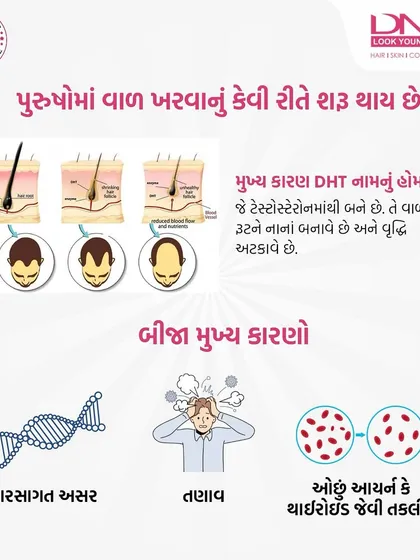 How does hair loss start in men? This graphic explains that the main cause is the hormone DHT, which shrinks hair follicles. Other major factors include genetics, stress, and underlying health issues like iron deficiency.