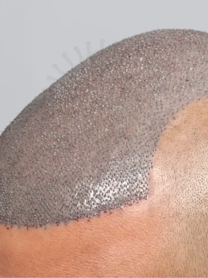 A powerful start for a Norwood Grade 6 case. 6000 grafts were used in a single session for full top coverage.