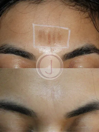 A clear view of a forehead scar before and after treatment. By combining different laser modalities, we can effectively remodel scar tissue and improve the overall appearance of the skin.