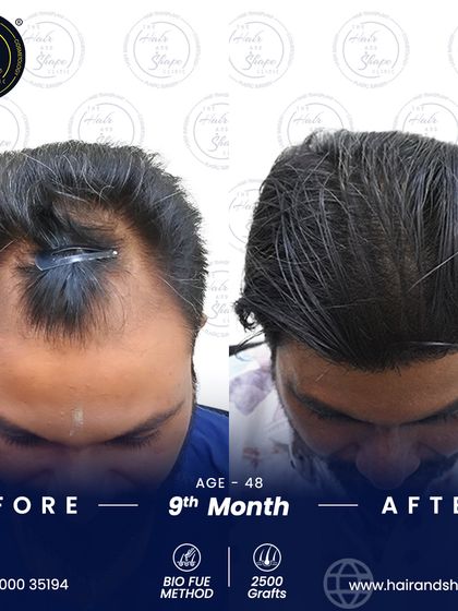 At 9 months, this patient's 2500-graft BIO FUE transplant shows excellent growth and coverage, turning back the clock on his hair loss.