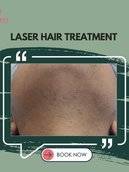 This image showcases the visible results of our advanced laser hair treatment. This non-invasive therapy works to stimulate dormant hair follicles and improve hair density over time.