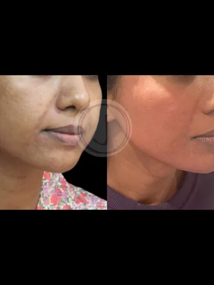 This before-and-after image highlights the improvement in the lower face and jawline definition. My goal with facial contouring is always to create natural-looking results that restore structure and youthfulness.