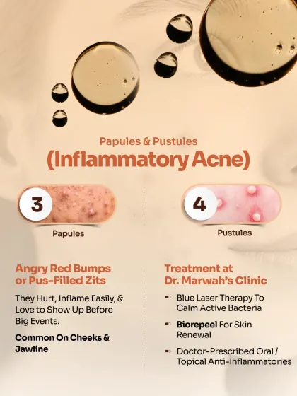 Inflammatory Acne, such as papules and pustules, appears as angry red bumps or pus-filled zits. Our treatment approach includes Blue Laser Therapy to calm bacteria, BioRePeel for skin renewal, and doctor-prescribed anti-inflammatories.