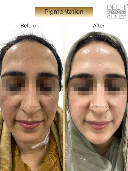 A full-face before and after showcasing the comprehensive results of our pigmentation treatment, leading to visibly brighter and clearer skin.