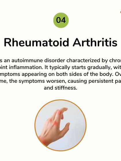 Rheumatoid Arthritis is an autoimmune disorder causing chronic joint inflammation. My treatment plan aims to manage the autoimmune response, reduce inflammation, and alleviate the persistent pain and stiffness associated with this condition.