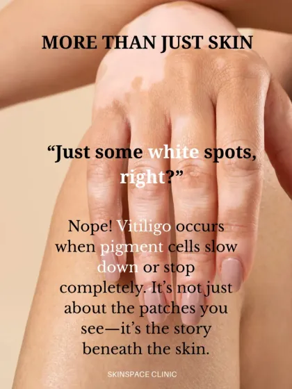 Vitiligo is more than just skin deep. It occurs when pigment-producing cells stop functioning. Understanding the science behind the patches is the first step in managing the condition.