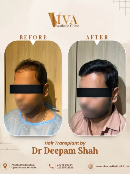 Another angle of the same patient. We focused on creating a dense frontal pack that flows naturally into the mid-scalp, giving the appearance of full, healthy hair.