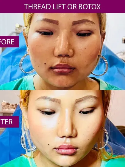 This is a great example of how a combination of treatments can achieve a significant yet natural-looking result. For this patient, I used a thread lift to contour the lower face and jawline, paired with Botox to refine the overall shape. The goal was to create a slimmer, more defined facial structure.