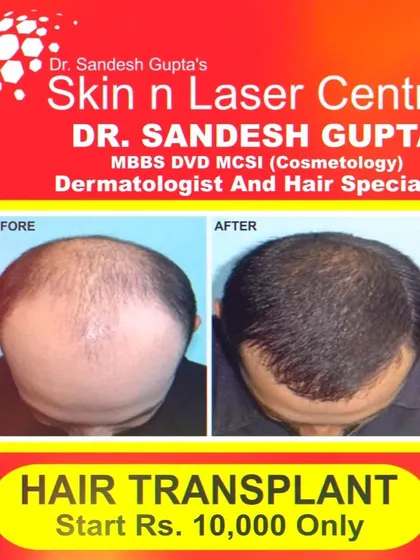 This is a clear example of how a successful FUE hair transplant can completely restore a natural-looking hairline and reverse advanced baldness. The results are permanent, giving you back not just your hair, but your confidence.