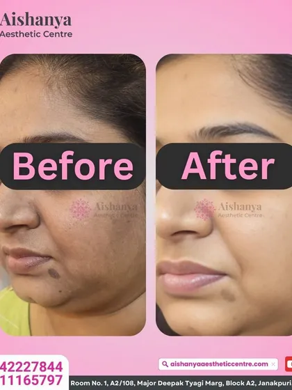 Another look at how we tackle pigmentation. The 'before' shows patches of dark spots and uneven tone, while the 'after' reveals a significantly brighter and more balanced complexion after our customized treatment plan.