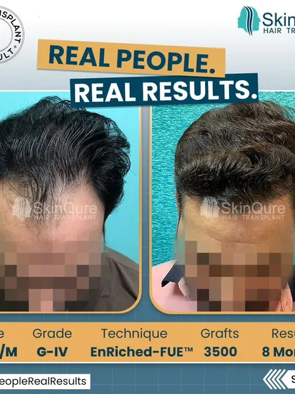 A top-down view of the 35-year-old patient with Grade IV hair loss. The 8-month result after 3500 grafts shows impressive coverage and density, effectively concealing the previously bald areas.