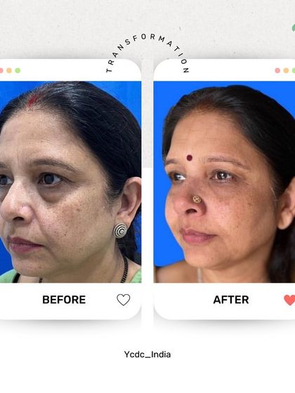 This profile view highlights the rejuvenating effect of correcting volume loss in the mid-face and under the eyes. The patient looks noticeably fresher and less tired, all achieved with skillfully placed fillers.