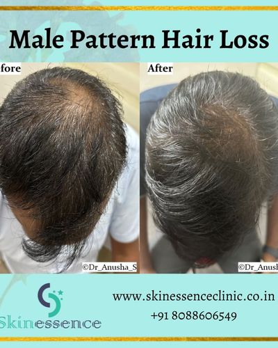 Hair Restoration & Scalp Treatments