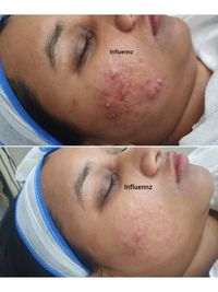 Acne & Scar Management