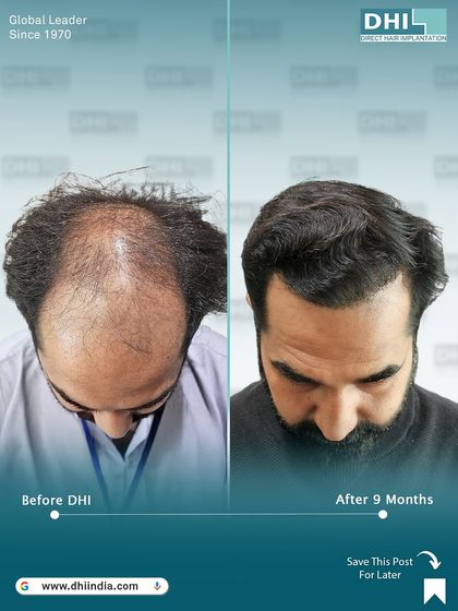 A top-down view showcasing the significant density improvement 9 months post-procedure. This angle provides a clear picture of the comprehensive coverage achieved with our DHI hair transplant.