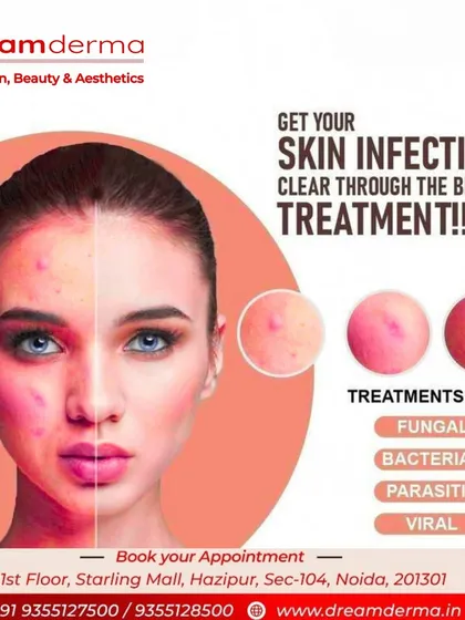 Skin infections can be fungal, bacterial, parasitic, or viral. It's crucial to get the right diagnosis for the best treatment. We provide expert care to clear all types of skin infections.