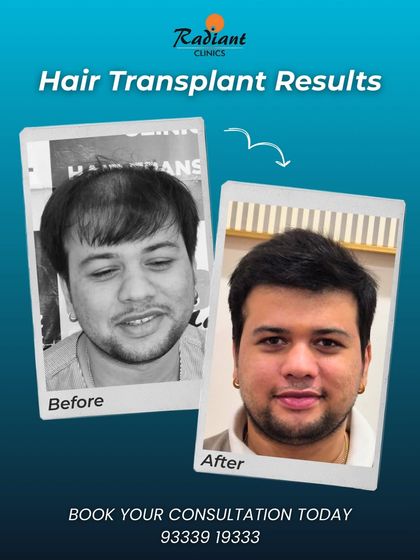 From significant thinning on top to a full head of hair, this transformation is a testament to what is possible with a well-planned hair transplant. The patient's satisfaction is evident.