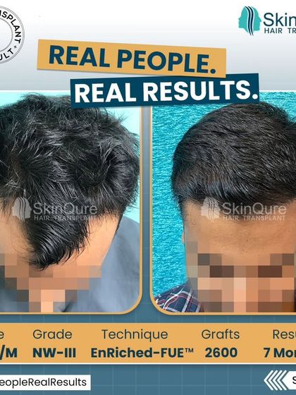 This 24-year-old patient presented with Norwood Grade III hair loss. We transplanted 2600 grafts, focusing on rebuilding a strong hairline and filling the thinning temples. The 7-month result shows significant growth and a much fuller look.