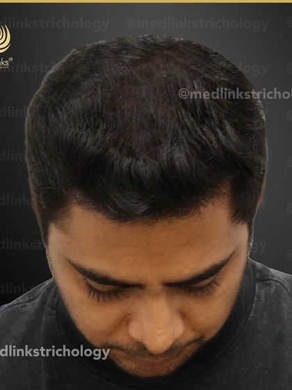 The top-down view after the transplant, showcasing the full coverage achieved.