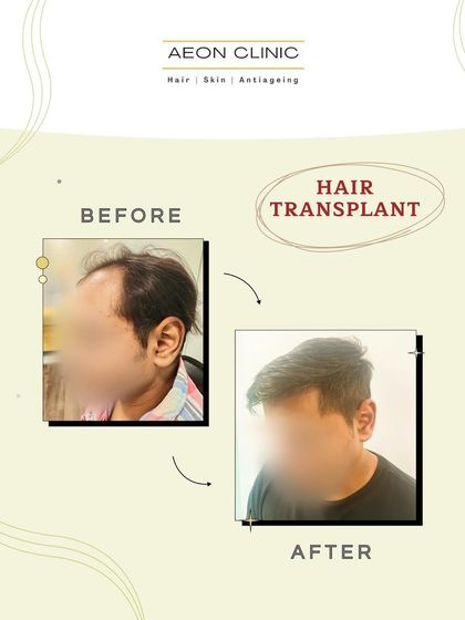 A side-profile transformation that demonstrates how a restored hairline can completely change your look and boost your confidence.