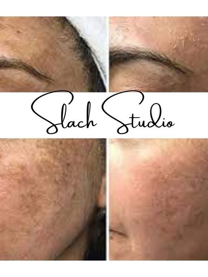 This before-and-after shows a significant improvement in skin clarity, with pigmentation and blemishes visibly reduced.