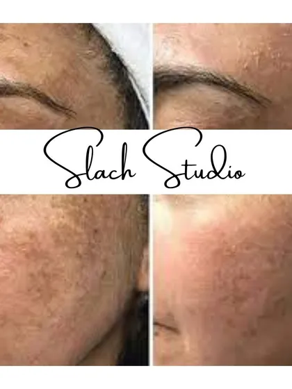 This before-and-after shows a significant improvement in skin clarity, with pigmentation and blemishes visibly reduced.