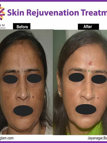 This client's transformation shows the power of our customized skin rejuvenation program in correcting severe pigmentation and sun damage. The result is a dramatically evened-out skin tone and a restored, healthy complexion.