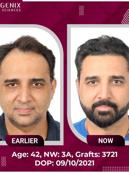 TV Actor Romanch Mehta shows his incredible transformation and explains how our results convinced him to overcome his fear of surgery.