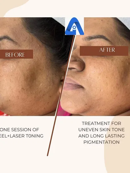 This is a real result from one of my patients after just a single session combining a chemical peel and laser toning. We targeted long-standing pigmentation and uneven skin tone, and you can see a significant improvement in clarity and texture.