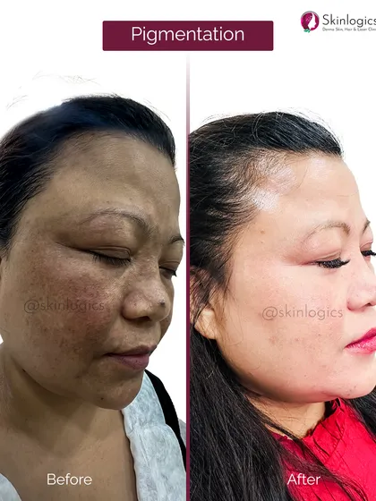 Another angle of the same patient as image 33, this photo confirms the comprehensive results of our pigmentation protocol, with visible improvement in skin tone and clarity.
