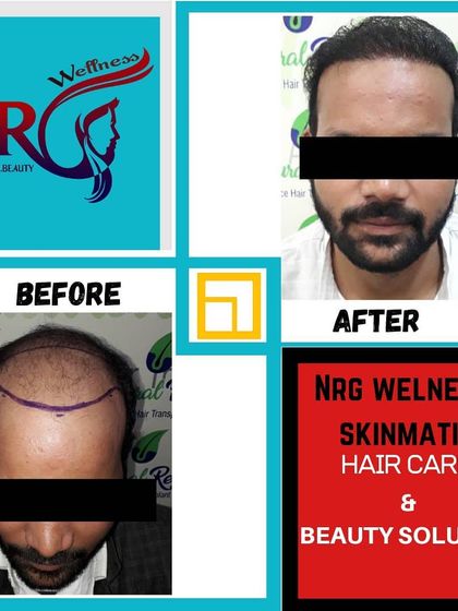Another example of our commitment to delivering guaranteed results. From extensive baldness to a full, natural hairline, we provide a complete hair and beauty solution.