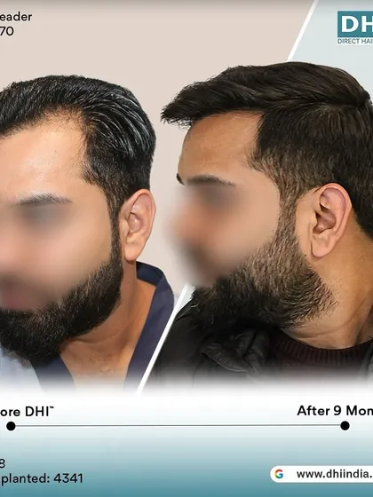 A side-profile view of the same client's 9-month transformation. The restored hairline and temple points create a sharp, defined look, showcasing the artistic precision of our DHI surgeons.